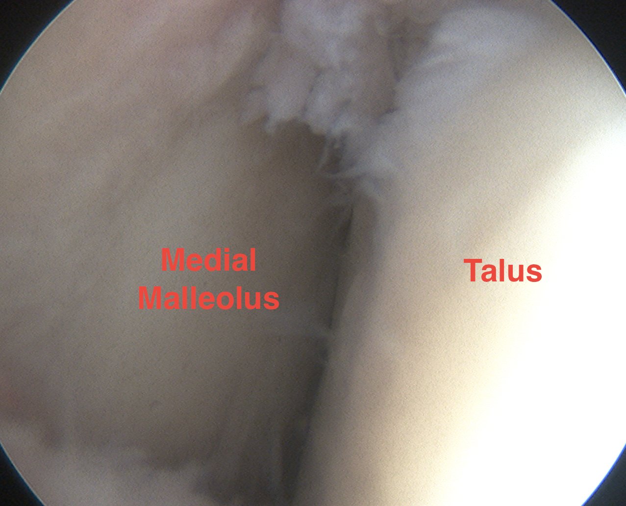 Ankle Scope Medial Gutter